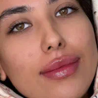 تزریق ژل و بوتاکس هایفو مزو پی ار پی ۸۹۹|خدمات زیبایی و سلامت|تهران, شکوفه (عبدل آباد)|دیوار