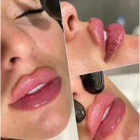 زیبایی طبیعی نه مصنوعی/فیلر و بوتاکس درکلینیک آرتا