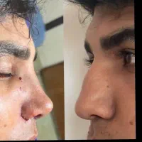 آف جراحی بینی ۲۵ت دراهواز لیفت وساکشن بلفارو