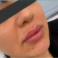 مدل تزریق فیلر لب