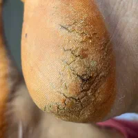 پدیکور پا ،رفع تیرگی ،قوزک پا