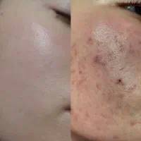 با ضد لک درمان قطعی رو تجربه کن