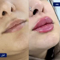 آموزش صفر تا صد زیبایی فیلر و بوتاکس و مزو تراپی|خدمات آرایشگری و زیبایی|اردبیل, |دیوار