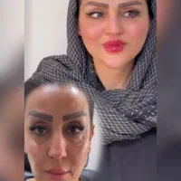 ژل لب / فول فیس / فیلر گونه / تخفیفات طلایی / پزشک
