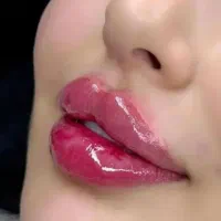 تزریق ژل و بوتاکس