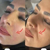 در افسریه ژل و فیلر مزوتراپی چربی سوز غبغب جوانساز|خدمات آرایشگری و زیبایی|تهران, افسریه شمالی|دیوار