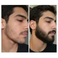 بمب رویش مجدد مو