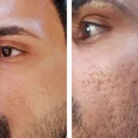 ریشت تکه ای در میاد اول علت رو بشناس