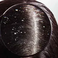 شامپو ضد شوره