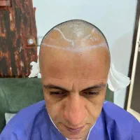 کاشت مو اقساطی/میکروگرافت