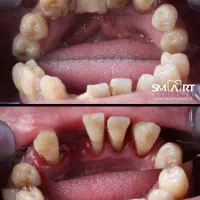 فقط امروز جرم گیری فک بالا و پایین