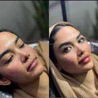 تخفیف جشنواره تزریق ژل و فیلر لب و فول فیس در مطب|خدمات آرایشگری و زیبایی|اصفهان, ملکشهر|دیوار