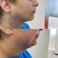 ساکشن غبغب و شکم فیلر بادی پی ار پی ژل و بوتاکس