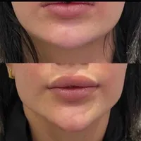 تزریق ژل فیلر لب،گونه،چانه،زاویه،بینی|خدمات آرایشگری و زیبایی|رشت, رشتیان|دیوار