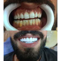 انجام کامپوزیت ونیر با بهترین متریال با افر ۶۰٪