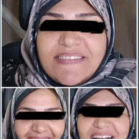 دندان دندانسازی پروتز با چک|خدمات آرایشگری و زیبایی|مشهد, موعود|دیوار