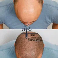 کاشت مو،ابرو،ریش