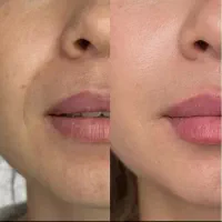 هایفوجوان سازی ولیفت‌صورت وغبغب (نتیجه آنی)