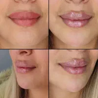 تزریق انواع فیلر لب و صورت