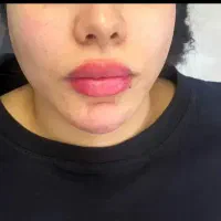 بوتاکس مصپورت.تزریقات وپانسمان و سوراخ کردن گوش|خدمات آرایشگری و زیبایی|اراک, |دیوار
