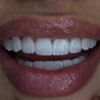 کامپوزیت دندان/کامپوزیت لب شیشه/طرح لبخند