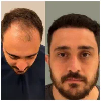 کاشت مو /کاشتمو/کاشتمو شیراز|خدمات آرایشگری و زیبایی|شیراز, قصرالدشت|دیوار