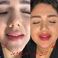 تزریق ژل فیلر بوتاکس و نخ لیفت با قیمت باورنکردنی|خدمات آرایشگری و زیبایی|رشت, گلسار|دیوار