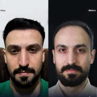 اقتصادی ترین کلینیک کاشت مو و ابرو در تهران/ اقساط|خدمات آرایشگری و زیبایی|تهران, سعادت‌آباد|دیوار