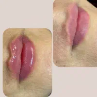 تزریق فیلر، جوانساز،بوتاکس توسط پزشک/ لیفت صورت