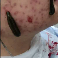 انواع حجامت، زالودرمانی، بادکش، کایروپراکتیک
