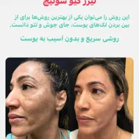 کربن تراپی لیزر کیوسوئیچ بستن منافذ|خدمات آرایشگری و زیبایی|دهدشت, |دیوار