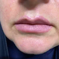 روشن کردن زیر بغل و بیکینی پاک کردن تاتو با لیزر