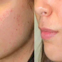 پاکسازی پوست تخصصی در سیدی فقط (۴۵۰) با برند MND