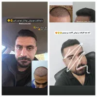 کاشت مو و ریش بیگی