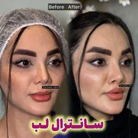 بلفاروپلاستی-سانترال لب-بوکال فت-ساکشن غبغب|خدمات آرایشگری و زیبایی|تهران, پاسداران|دیوار