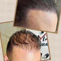 میکرو اسکالپ|خدمات آرایشگری و زیبایی|تهران, جنت‌آباد جنوبی|دیوار
