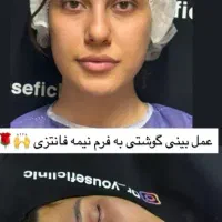 جشنواره ویژه جراحی بینی رینوپلاستی قیمت استثنایی|خدمات آرایشگری و زیبایی|جوانرود, |دیوار