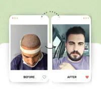 کاشت مو در شیراز / اقامت رایگان