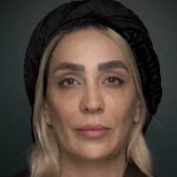 لیفت با نخ مزوژل بوتاکس