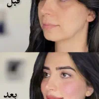 لیفت صورت نخ،ژل لب بوتاکس هایفو لیزر موتیتانیومprp