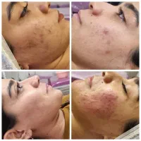 آموزش تخصصی  فیشال و پاکسازی