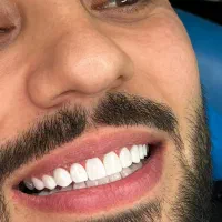 کامپوزیت دندان جشنواره لمینت ایمکس|خدمات آرایشگری و زیبایی|تهران, شمس‌آباد|دیوار