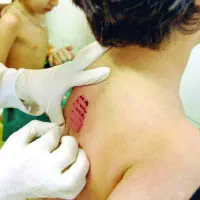 حجامت زالو درمانی بادکش گرم بانوان