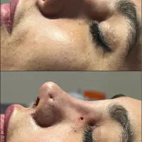 اف عمل زیبایی بینی|خدمات آرایشگری و زیبایی|دهدشت, |دیوار