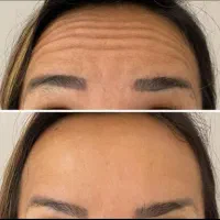 ژل و بوتاکس تخفیف 50 درصدی با چک صیادی|خدمات آرایشگری و زیبایی|مشهد, فلسطین|دیوار