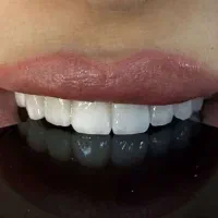 +جشنواره ویژه تا عید نوروز ایمپلنت ترمیمی زیبایی +