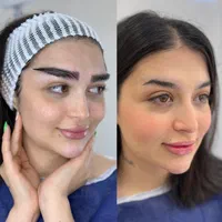 جشنواره تخفیف ۵۰ درصدی کاشت ابرو تخصصی