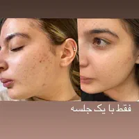 فشیال پاکسازی لیزر پوست جوانساز|خدمات آرایشگری و زیبایی|شیراز, معالی‌آباد|دیوار