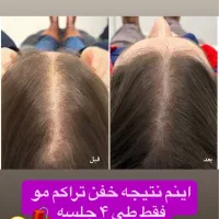 درمان ریزش مو و رویش مجدد با بهترین متریال|خدمات آرایشگری و زیبایی|تهران, امام حسین|دیوار