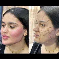 بوتاکس وفیلر صورت و بدن